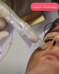 نمونه مزونیدلینگ کلینیک گلدن رویال