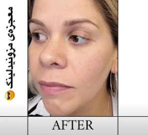 نمونه مزونیدلینگ کلینیک گلدن رویال