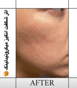 نمونه مزونیدلینگ کلینیک گلدن رویال