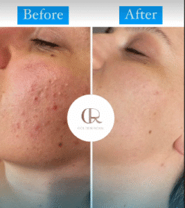 نمونه مزونیدلینگ کلینیک گلدن رویال