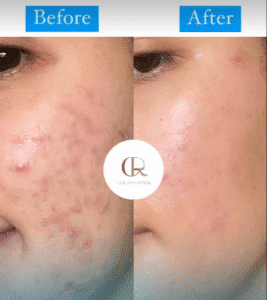 نمونه مزونیدلینگ کلینیک گلدن رویال