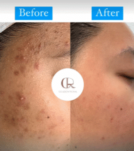 نمونه مزونیدلینگ کلینیک گلدن رویال