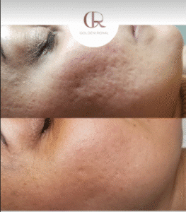 نمونه مزونیدلینگ کلینیک گلدن رویال