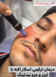 نمونه مزونیدلینگ کلینیک زیبایی اسپادانا