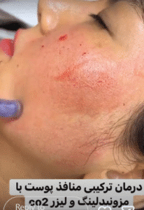 نمونه مزونیدلینگ کلینیک زیبایی اسپادانا