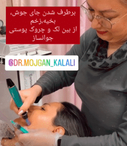 نمونه مزونیدلینگ دکتر مژگان کلالی