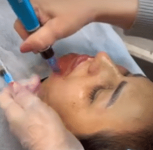 نمونه مزونیدلینگ دکتر مژگان کلالی