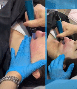 نمونه مزونیدلینگ دکتر مژگان کلالی