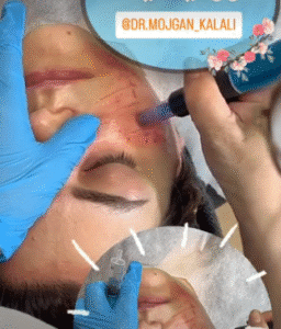 نمونه مزونیدلینگ دکتر مژگان کلالی