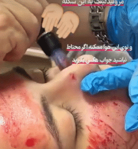 نمونه مزونیدلینگ دکتر مژگان کلالی