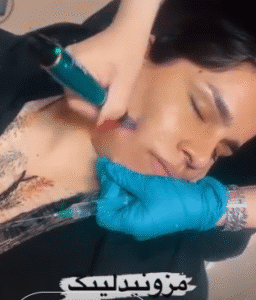 نمونه مزونیدلینگ دکتر مژگان کلالی