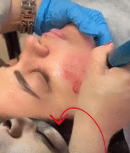 نمونه مزونیدلینگ دکتر مژگان کلالی