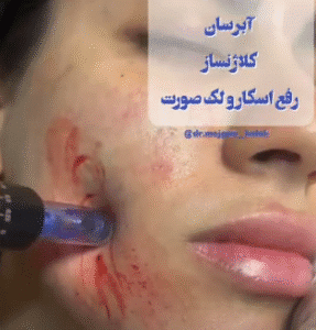 نمونه مزونیدلینگ دکتر مژگان کلالی