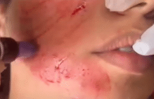 نمونه مزونیدلینگ دکتر مژگان کلالی