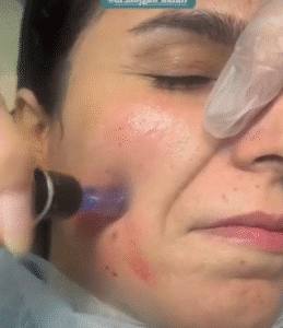 نمونه مزونیدلینگ دکتر مژگان کلالی