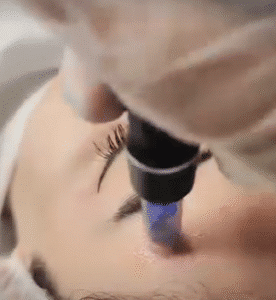 نمونه مزونیدلینگ دکتر مژگان کلالی