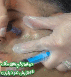 نمونه مزونیدلینگ دکتر مژگان کلالی