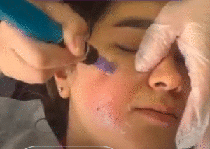 نمونه مزونیدلینگ دکتر مژگان کلالی