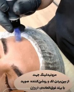 نمونه مزونیدلینگ کلینیک زیبایی آرمان